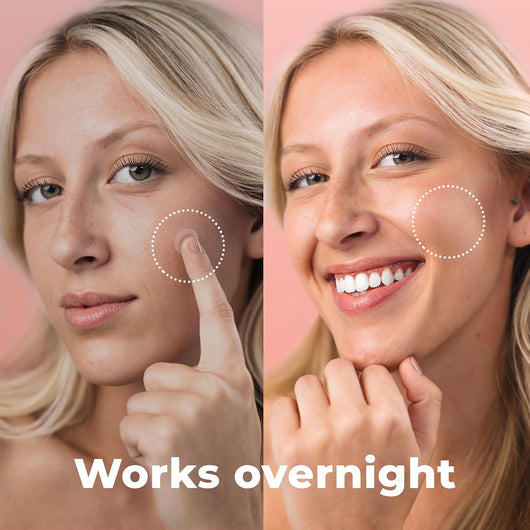 Korean Micro Needle Pimple Patches